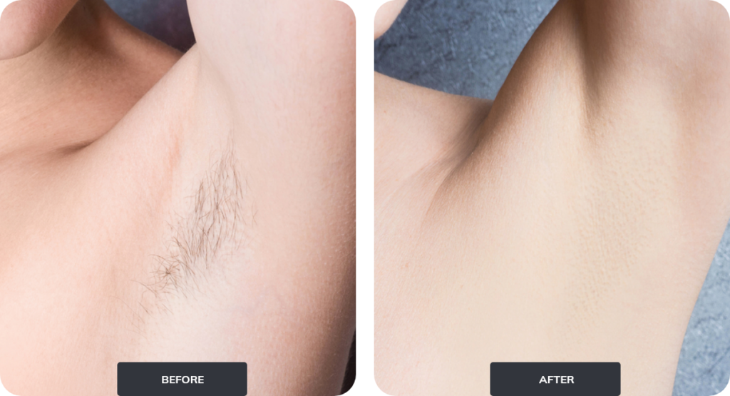 before and after of hair removal for armpits