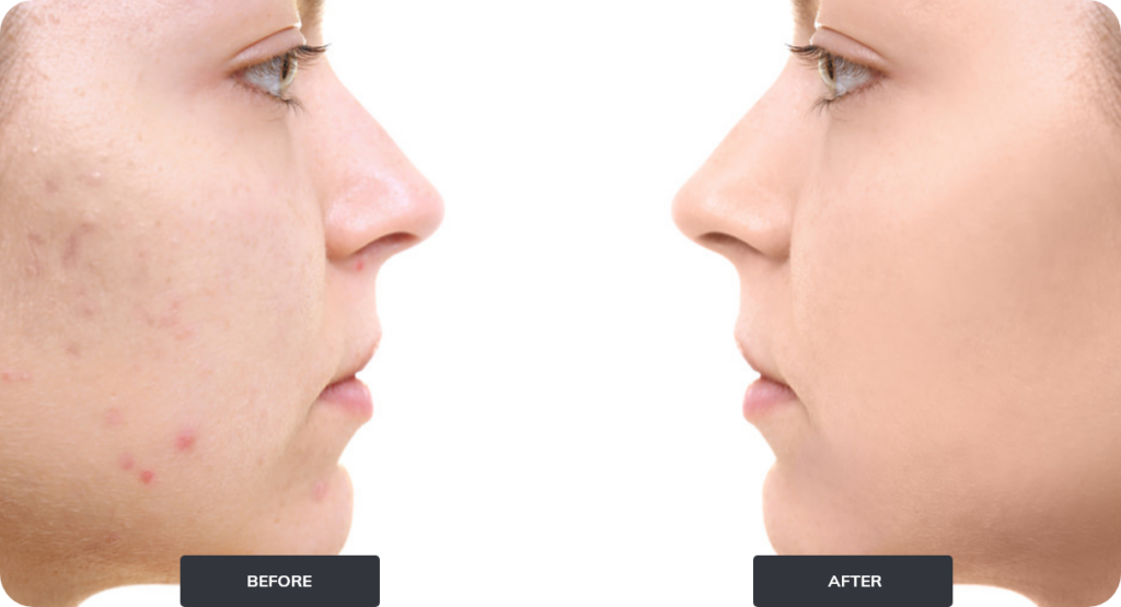 profile of face with acne before and after
