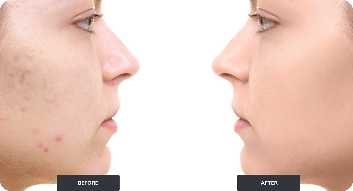 profile of face with acne before and after