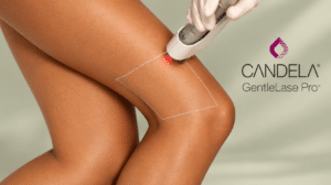 Laser hair removal in Boulder, Colorado at Vasu Skin Solutions